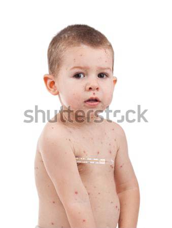 Little boy whit smallpox Stock photo © grafvision