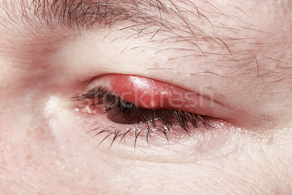 Dolorido vermelho olho inflamação médico médico Foto stock © gromovataya