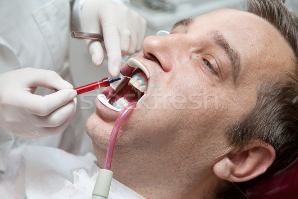 Stock photo: Man during teeth whitening process at the dentist office