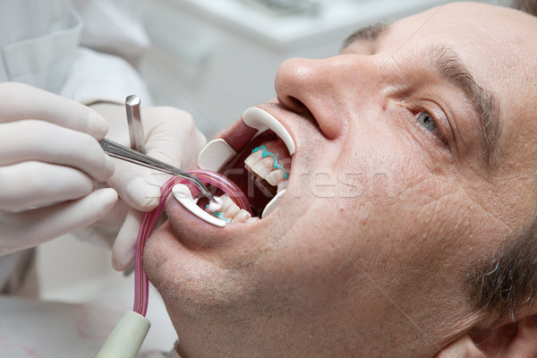 Férfi fogfehérítés folyamat fogorvosi rendelő iroda mosoly Stock fotó © gsermek