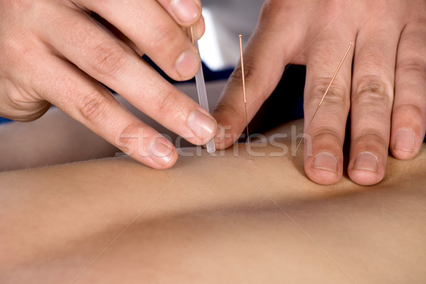Dorosły mężczyzna akupunktura powrót kobiet pacjenta Zdjęcia stock © handmademedia