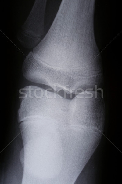 x-ray Stock photo © Hasenonkel
