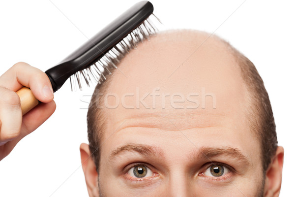 Chauve homme tête humaine cheveux perte Photo stock © ia_64