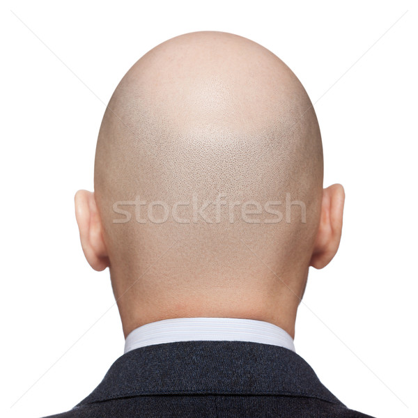 Bald Mann Kopf menschlichen Haar Verlust Stock foto © ia_64