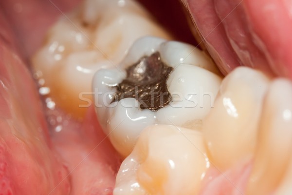 Vulling macro tand tanden slechte behandeling Stockfoto © icefront
