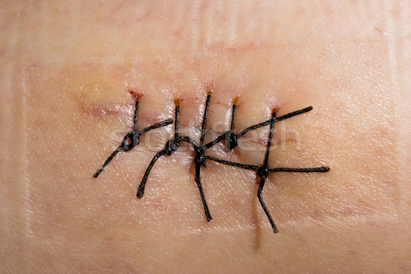 Cicatriz primer plano Foto puntada salud medicina Foto stock © iko