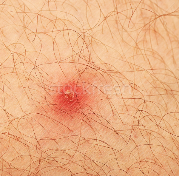 Stock photo: pimple extreme on human skin. macro