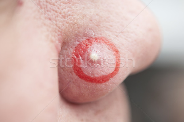 Stock photo: close-up of pimple