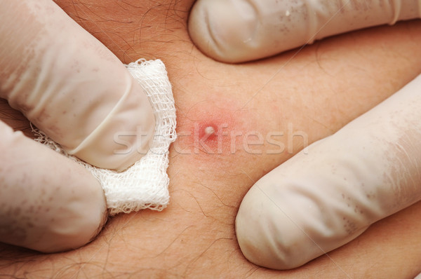 Doctor in gloves squeezes a pimple Stock photo © inxti