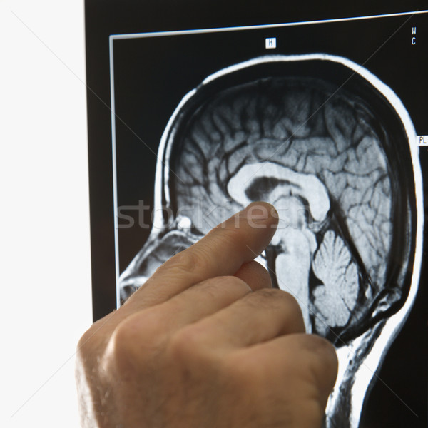 Kezek mutat röntgen kaukázusi férfi kéz Stock fotó © iofoto