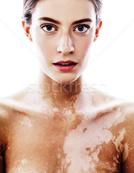 young pretty brunette real modern woman with vitiligo desease close up Stock photo © iordani