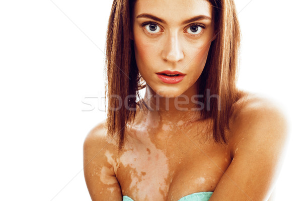 beautiful young brunette woman with vitiligo disease close up isolated on white positive smiling, mo Stock photo © iordani