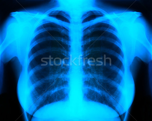 x-ray Stock photo © IvicaNS