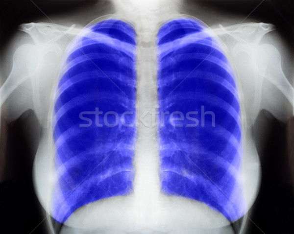 Xray immagine umani petto medici diagnosi Foto d'archivio © IvicaNS