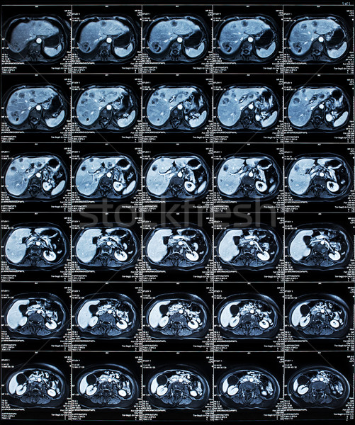 Mri abdomen escanear humanos médicos Foto stock © IvicaNS