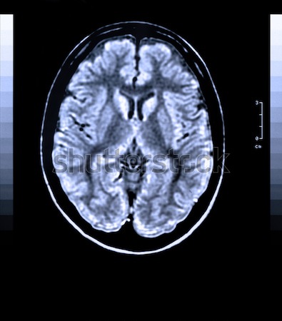 Cérebro humano saúde médico imagem mri magnético Foto stock © IvicaNS