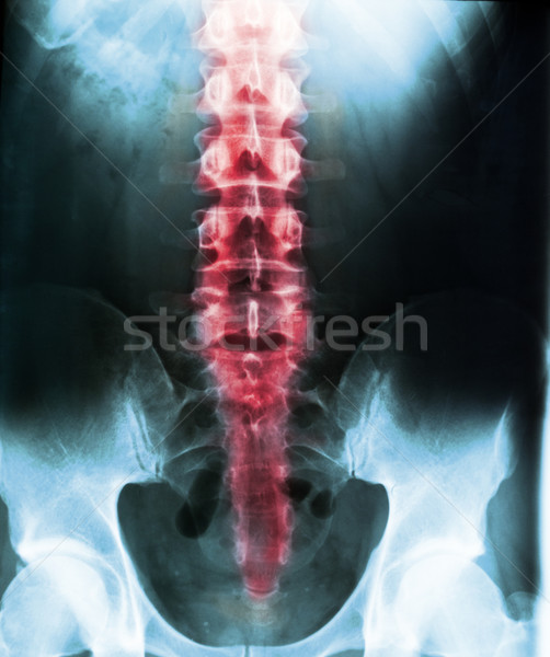 Gerincoszlop piros emberi test röntgen orvosi Stock fotó © IvicaNS