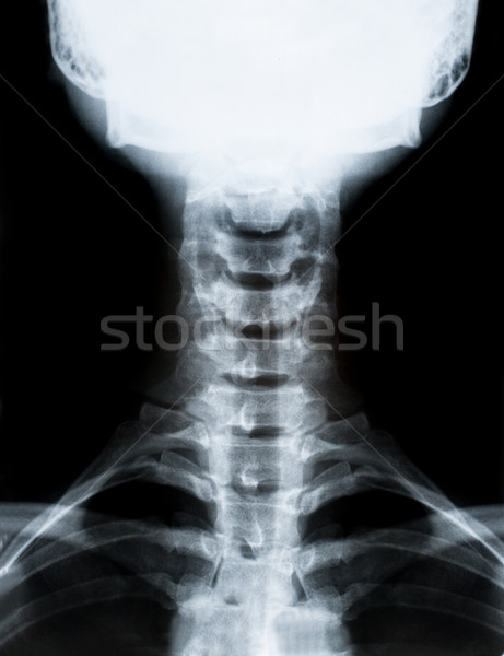 Xray imagine gât sira spinarii izolat negru Imagine de stoc © IvicaNS