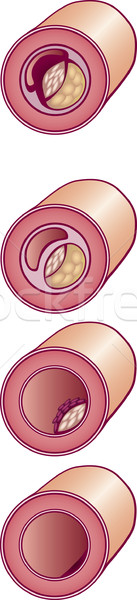 Bad cholesterol in vein Stock photo © izakowski