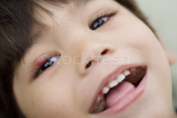 Little boy with a sty on his eye smiling at camera Stock photo © jarenwicklund
