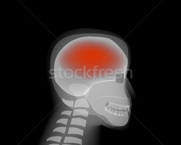 Headache,stroke, Brain Diseases,Alzheimer Stock photo © jiaking1