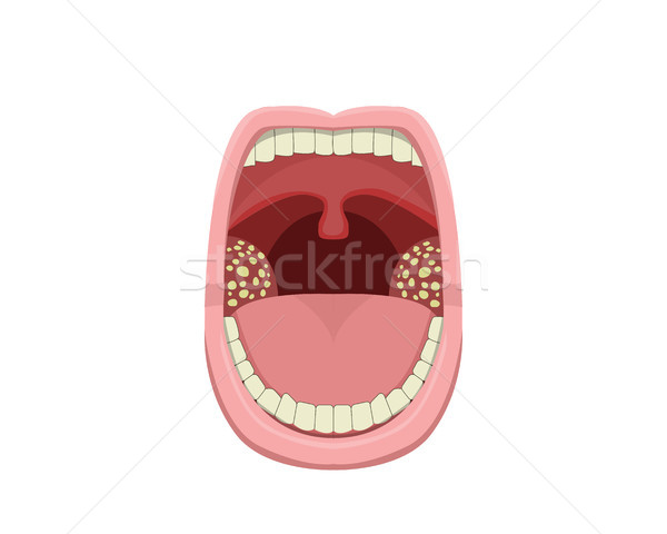 Inflamed Tonsillitis in vector design Stock photo © jiaking1