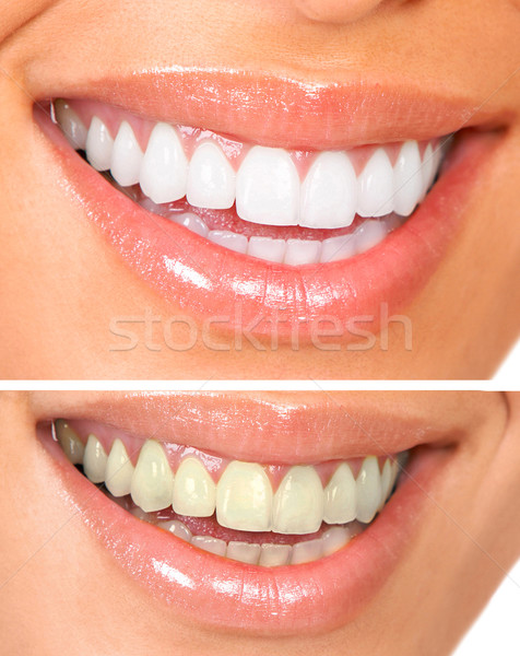 Sănătos albirea dintilor femeie dinti albi fericit Imagine de stoc © Kurhan