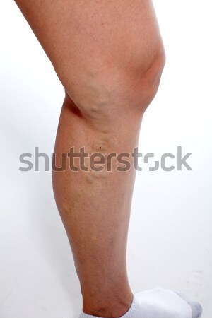 Varicose veins. Stock photo © Kurhan