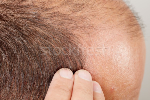 Hair loss. Stock photo © Kurhan