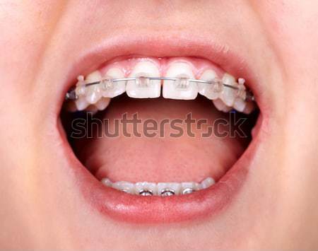 Zęby ortodontyczne stomatologicznych uśmiech medycznych Zdjęcia stock © Kurhan