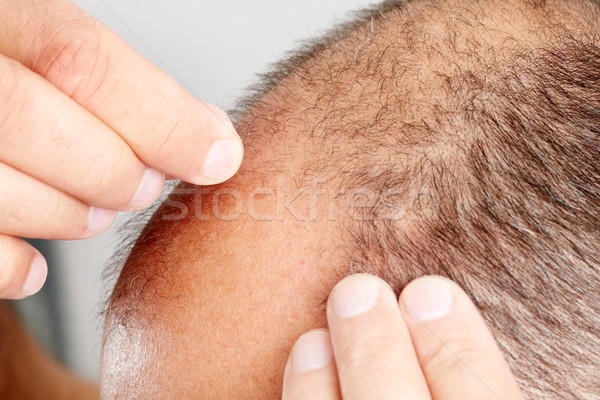 Stock photo: Hair loss.