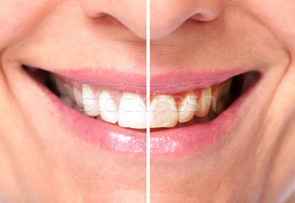 Sağlıklı kadın dişler diş ortodontik sağlık Stok fotoğraf © Kurhan