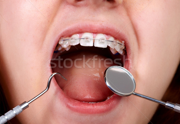 Fogak fogszabályozási fogászati egészségügy orvosi gyermek Stock fotó © Kurhan