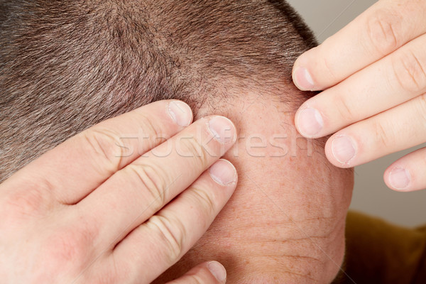 Hair loss. Stock photo © Kurhan