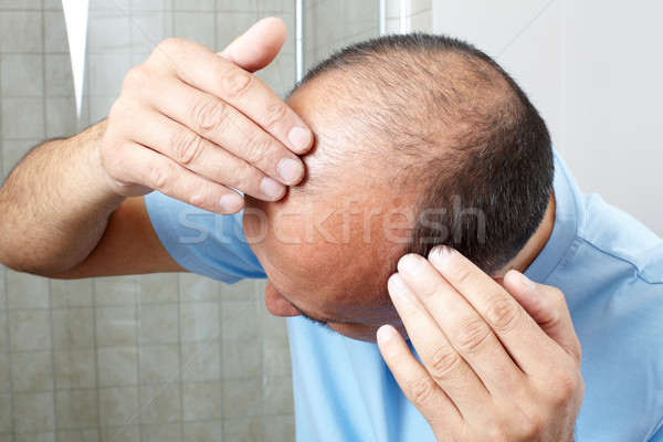 Pelo pérdida hombre tocar cabeza manos Foto stock © Kurhan
