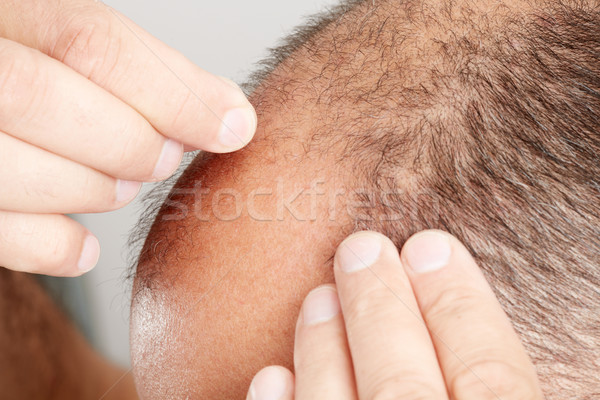 Hair loss. Stock photo © Kurhan