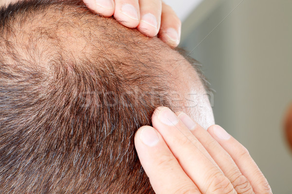 Hair loss. Stock photo © Kurhan