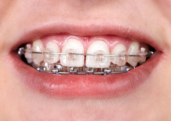 Zęby ortodontyczne stomatologicznych uśmiech medycznych Zdjęcia stock © Kurhan