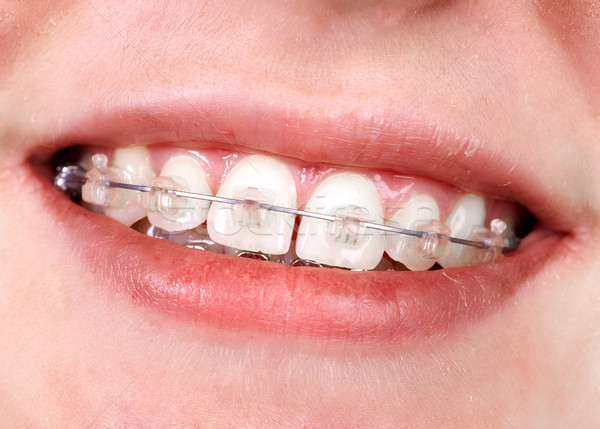 Teeth with orthodontic brackets. Stock photo © Kurhan