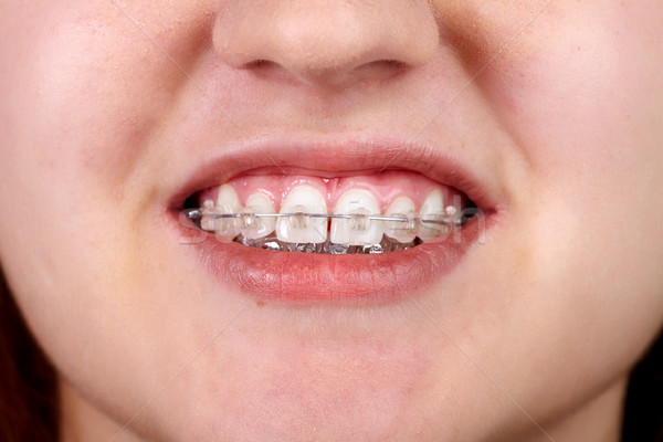 Zähne kieferorthopädischen zahnärztliche Gesundheitspflege Lächeln medizinischen Stock foto © Kurhan