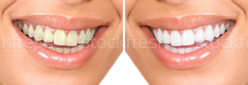 Foto stock: Saudável · atendimento · odontológico · mulher · dentes · brancos · feliz