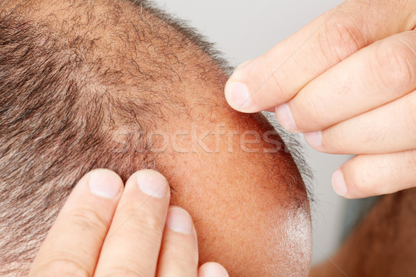 Stock photo: Hair loss.