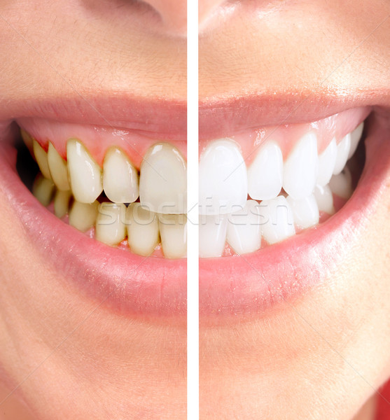 Sonrisa saludable hermosa dentales salud blanqueo Foto stock © Kurhan