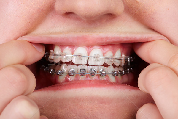 Tanden orthodontische tandheelkundige gezondheidszorg glimlach medische Stockfoto © Kurhan