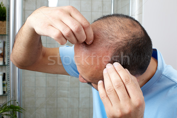 頭髮 損失 男子 觸摸 頭 手 商業照片 © Kurhan