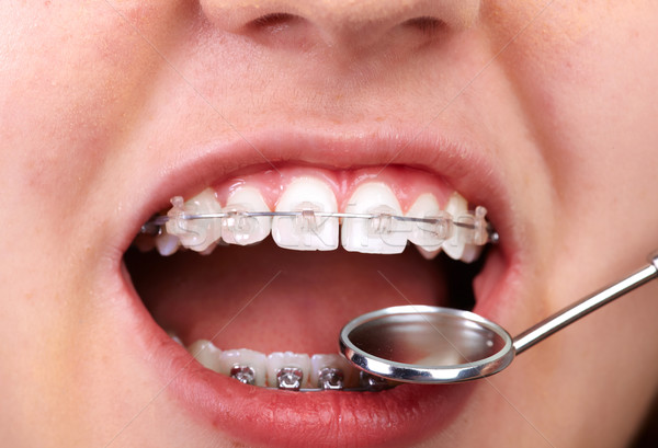 Teeth with orthodontic brackets. Stock photo © Kurhan