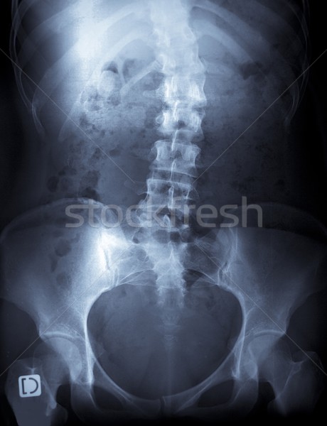 Stock photo: x-ray of a young female spine