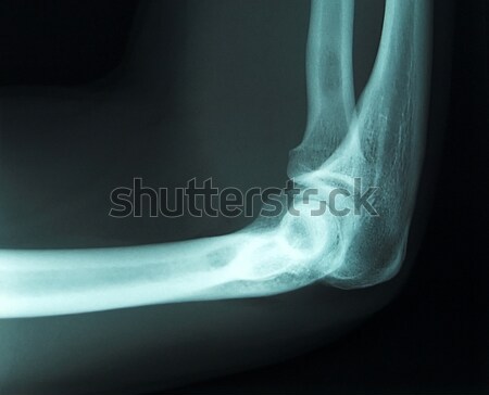 Raio x masculino braço articulação Foto stock © ldambies