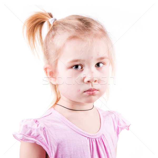 Sick little girl with chickenpox Stock photo © Len44ik