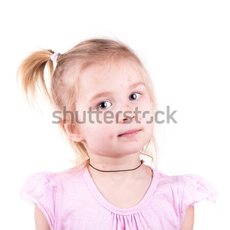Sick little girl with chickenpox Stock photo © Len44ik